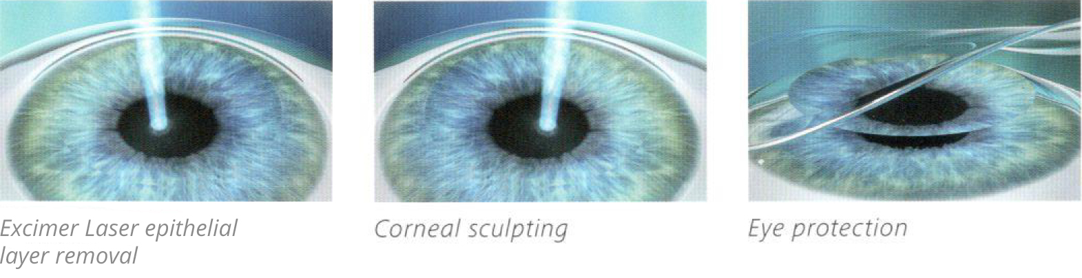 Augenlaser-Methoden mit Oberflächenbehandlung: PRK, LASEK, Epi-LASIK