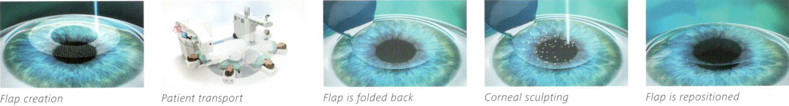 Augenlaser-Methoden mit Flapschnitt: Femtolasik 6D, Z-LASIK& iLASIK